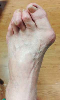 hallux valgus o juanete