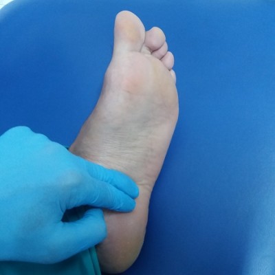 fascitis-plantar