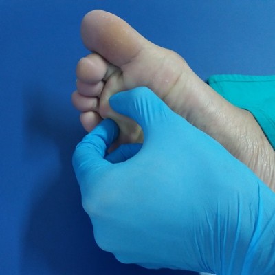 neuroma morton